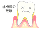 歯槽骨の破壊