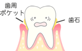 歯周炎
