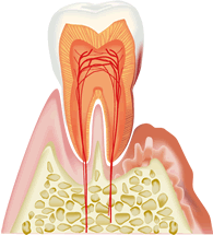 歯周病とは